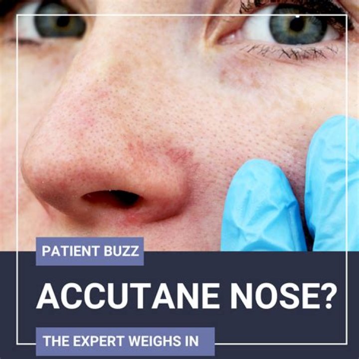 Accutane Nose Job: What You Need to Know Before Considering Surgery