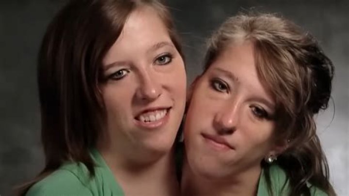 Conjoined Twins Abby and Brittany: Navigating Pregnancy and Life's Challenges