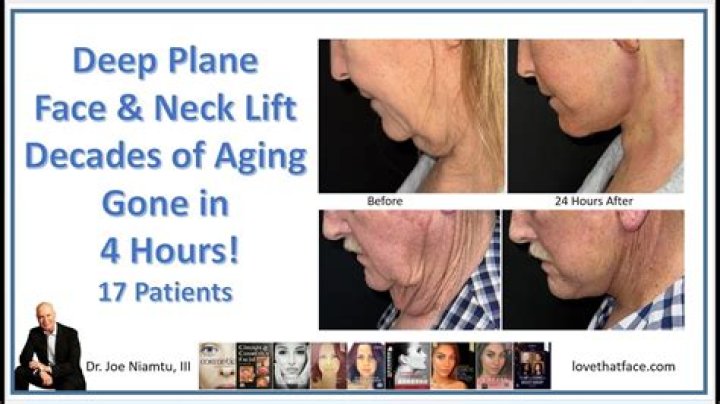 Logical Approaches to the Deep Plane and Facial Aging: Free Download Insights