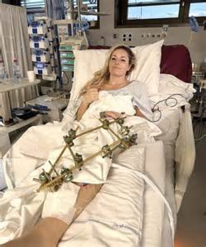 Mason's Journey: Understanding Leg Amputation Surgery and Recovery