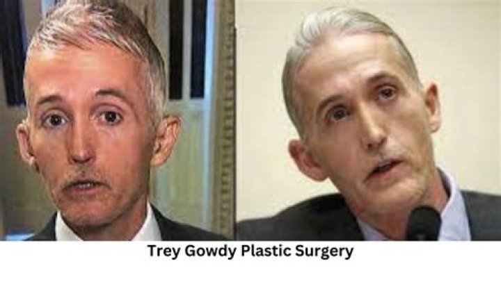 Trey Gowdy's Journey: Understanding the Speculations Around His Nose Surgery