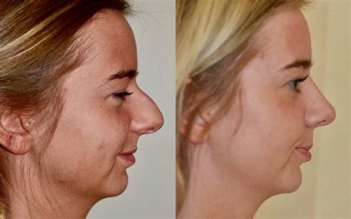 Trey Gowdy's Nose Transformation: A Closer Look at His Before and After