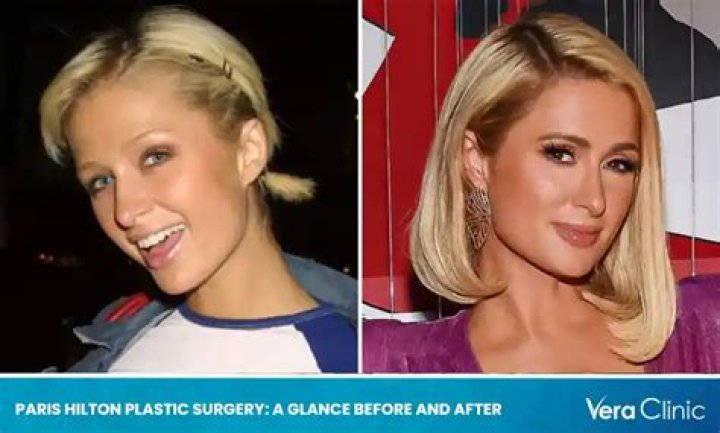 Unveiling the Truth Behind Paris Hilton's Plastic Surgery Journey