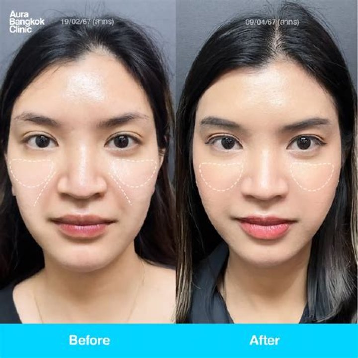 When Ultherapy Goes Wrong: Unveiling the Risks and Realities